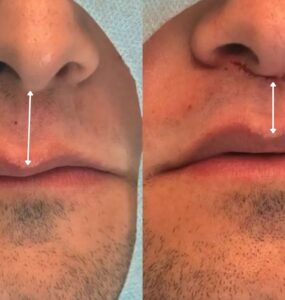 Lip Lift amplia opções de rejuvenescimento sem volume