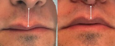 Lip Lift amplia opções de rejuvenescimento sem volume