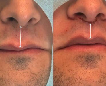 Lip Lift amplia opções de rejuvenescimento sem volume