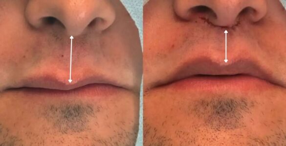 Lip Lift amplia opções de rejuvenescimento sem volume