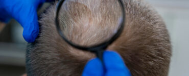 Tricologia ganha espaço no cuidado com a queda capilar