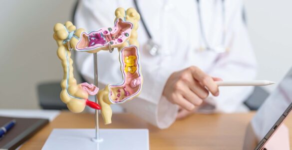 Campanha Março Azul alerta para o câncer colorretal