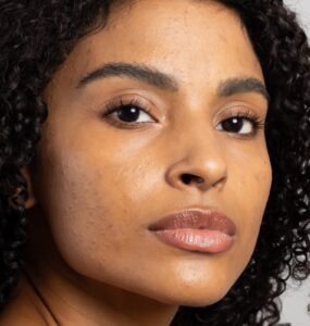 Mês de Conscientização da Acne incentiva cuidados especiais