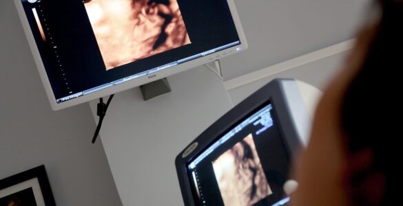 Pesquisa reforça técnica fetal para hérnia diafragmática