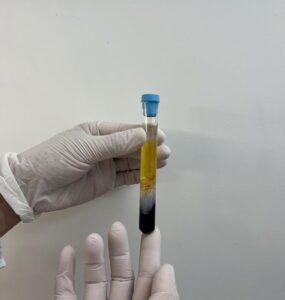 CFM regulamenta PRP em condições osteomusculares