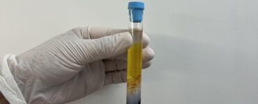 CFM regulamenta PRP em condições osteomusculares