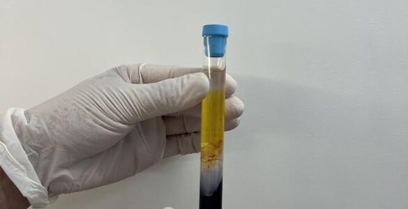 CFM regulamenta PRP em condições osteomusculares