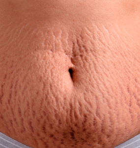 Cirurgia plástica e estética se aliam contra as estrias