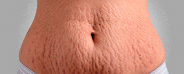 Cirurgia plástica e estética se aliam contra as estrias