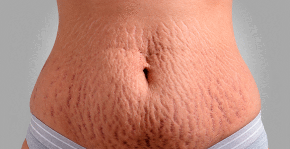 Cirurgia plástica e estética se aliam contra as estrias