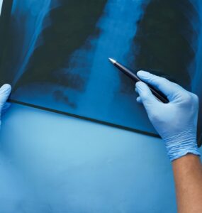 CONITEC abre consulta para Hipertensão Arterial Pulmonar