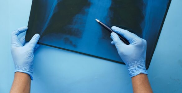 CONITEC abre consulta para Hipertensão Arterial Pulmonar