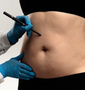 Lipoaspiração lidera preferência por cirurgias plásticas