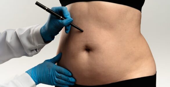 Lipoaspiração lidera preferência por cirurgias plásticas
