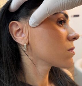 Lifting facial endoscópico dispensa cicatriz visível
