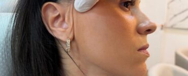 Lifting facial endoscópico dispensa cicatriz visível
