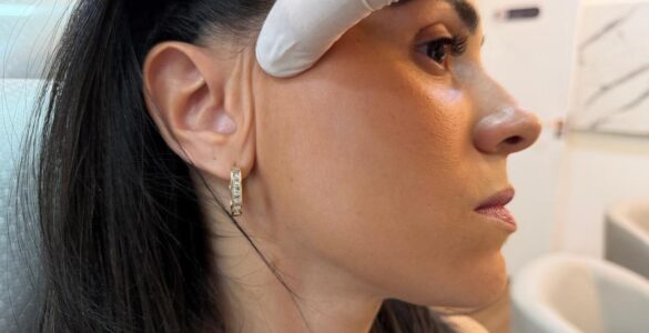 Lifting facial endoscópico dispensa cicatriz visível