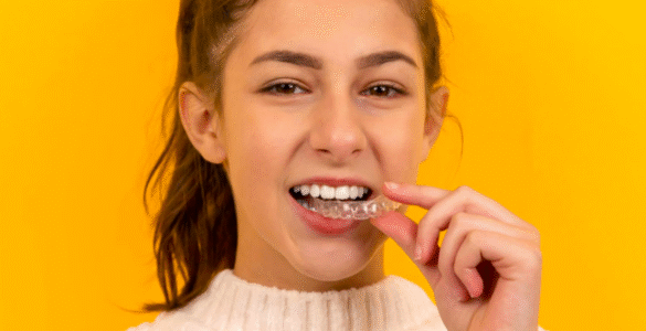 Alinhador invisível: como funciona o tratamento dentário