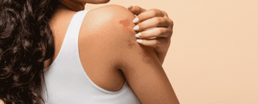 Mês da Dermatite Atópica: os impactos da doença na pele