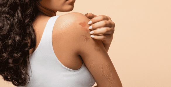 Mês da Dermatite Atópica: os impactos da doença na pele