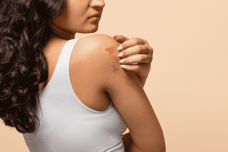 Mês da Dermatite Atópica: os impactos da doença na pele