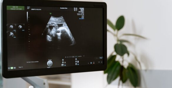 Vilo corial tem diagnóstico genético precoce