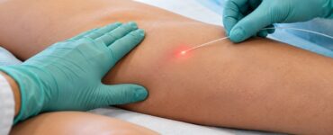 Laser permite tratar a safena sem retirar a veia da perna