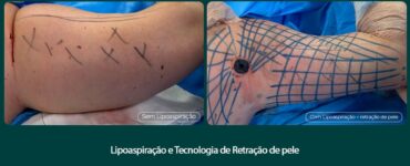 Tratamento remove flacidez do braço com tecnologia associada