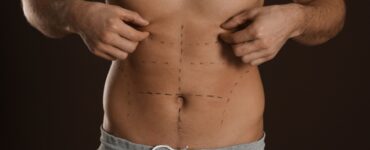 Definição em foco: a evolução da lipoaspiração masculina