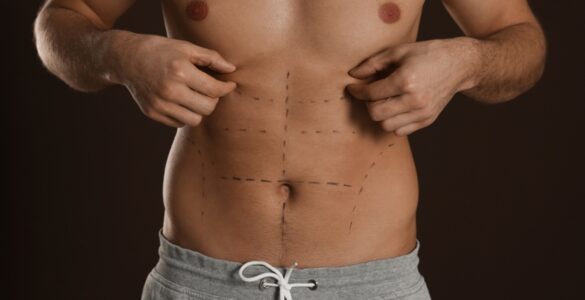 Definição em foco: a evolução da lipoaspiração masculina