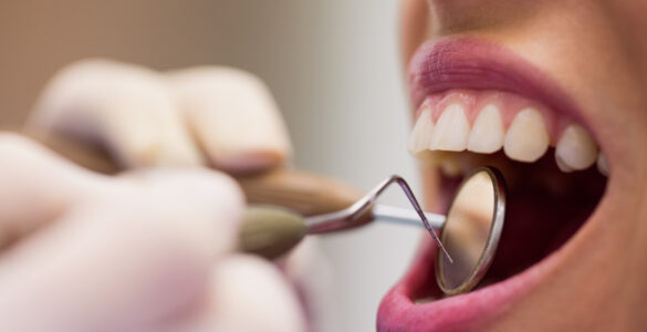 Sangramento na gengiva pede avaliação, alerta dentista