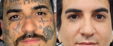 Remoção de tatuagem cresce e muda perfil de quem procura